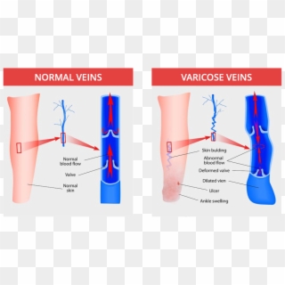 Open Skin Ulcers - Normal Vein Vs Varicose Vein Clipart