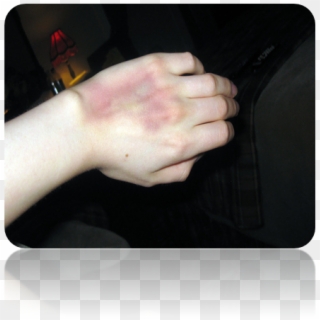 Ivhand-bruise - Netbook Clipart