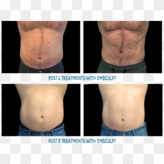 Male Abs Before And After - Emsculpt Before And After Men Clipart