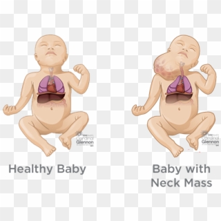 Fetal Neck Masses - Fetal Teratoma Neck Clipart
