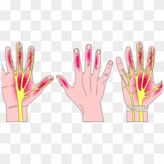 Carpal Tunnel Syndrome Painting Clipart