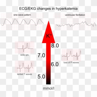 Hyperkalemia6 - Hyperkalemia Ecg Changes Clipart