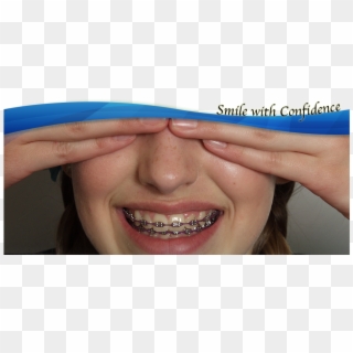 Life With Braces - Close-up Clipart