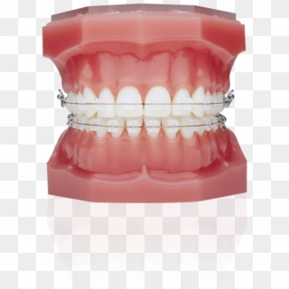 Ice Clear Braces Clipart