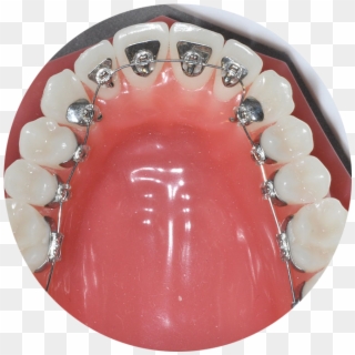 Lingual Braces - Orthodontics Clipart