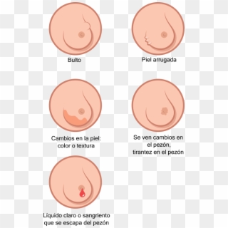 Breast Cancer Illustration Es - El Pezón Sangriento Clipart