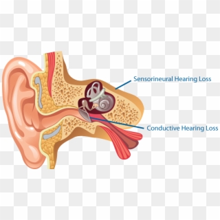 Loss Png - Types Of Hearing Loss Clipart