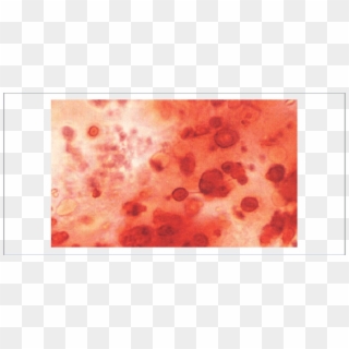 A Synovial Fluid Wet Smear Stained With Alizarin Red - Hydroxyapatite Crystals Alizarin Red Clipart