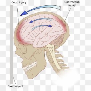 An Introduction To A Concussion A Bruise To The Brain - Charles Bonnet Syndrome Facts Clipart