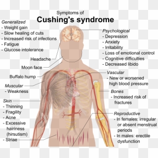 Cushing's Syndrome - Cushing's Syndrome Addison's Disease Clipart