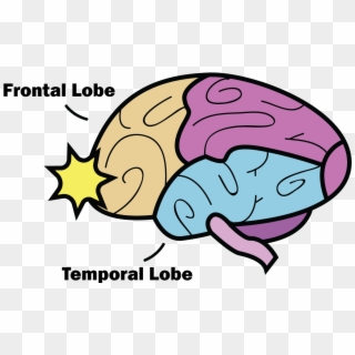The Anatomy Of A Concussion - Concussion Frontal And Temporal Lobe Clipart