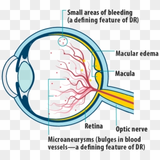 Picture Of Effects Of Dme/dr In Dme On The Eye, Showing - Central Retina Vein Occlusion Vs Clipart