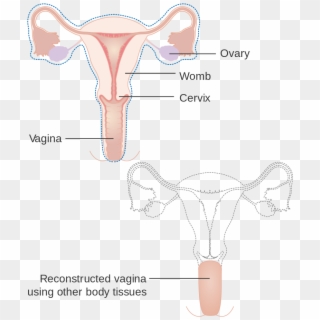 Diagram Showing A Radical Hysterectomy With A Reconstructed - Reconstructed Vagina Clipart