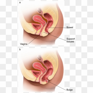 Illustration Showing A Normal Vagina And One With A - Posterior Prolapse Clipart