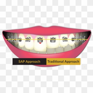 Saoly Benson Utilizes Smile Arc Protection When Treatment - Tongue Clipart