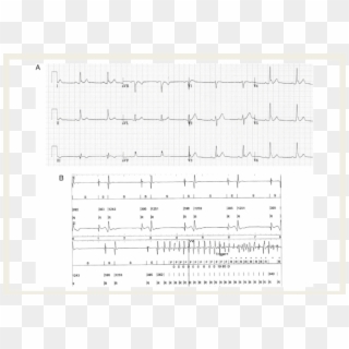 Global J Waves In A Patient Presenting With Electrical - Sheet Music Clipart