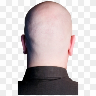 See Original Image Bald Person, Bald Heads, Hair Transplant, - Back Of Bald Head Transparent Clipart