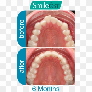 Aqd Smilefast After 6-months - Braces Before And After Buck Tooth Clipart