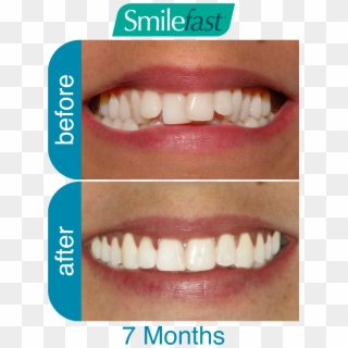 Aqd Smilefast After 7 Months2 Aqd Smilefast After 8 - Braces Before And After 8 Months Clipart