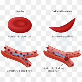 Png Freeuse Library What Is Sickle Anaemia Pinterest - Sickle Cell And Normal Cell Clipart