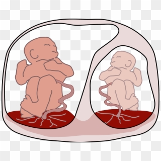 Twin To Twin Transfusion Syndrome - Polihidramnios Y Oligohidramnios Pdf Clipart
