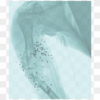 An X-ray Of A Shotgun Wound To The Upper Arm - Drawing Clipart
