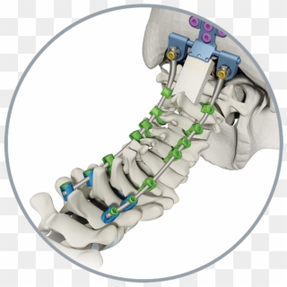 Atec Spine Products Solanas Featured Image - Bone Clipart