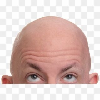 #ftestickers #people #man #head #bald - Baldness Hair Clipart