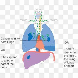 Tnm Staging Lung Cancer , Png Download - Stage 4 Lung Cancer Diagram Clipart