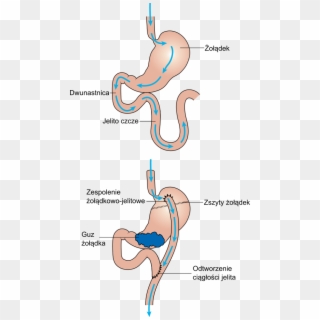 Diagram Showing Before And After Stomach Bypass Surgery Clipart