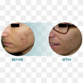 Active Acne/acne Scars - Smile Clipart
