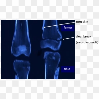 Tut's Leg Bones - King Tut Leg Fracture Clipart