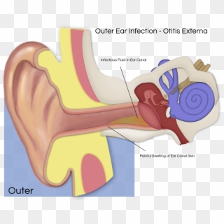 Ear Infection Png - Schwannoma Vestibular Png Clipart