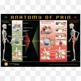 Anatomy Of Pain Poster - Disc Herniation Posters Clipart