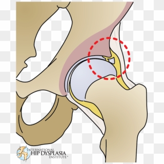 Black And White Library Labrum International Hip Dysplasia - Drawing Of Torn Labrum Hip Clipart
