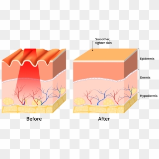 Red Light Therapy Users Have Reported A Noticeable - Microneedling Stretch Marks Diagram Clipart