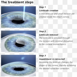 Description Of Treatment Steps With Smile - Lasik Smile Clipart