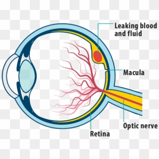 Picture Of Effects Of Wet Amd On The Eye, Showing Leaking - Leaky Blood Vessels In Eyes Clipart