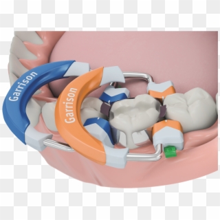 Garrison Dental 3d Fusion Diagram Clipart
