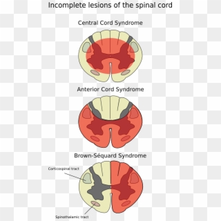 Anterior Spinal Artery Syndrome - Anterior Spinal Syndrome Clipart