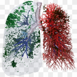 Functional Respiratory Imaging Yields Unparalleled - Lung Function Image Fluidda Copd Clipart
