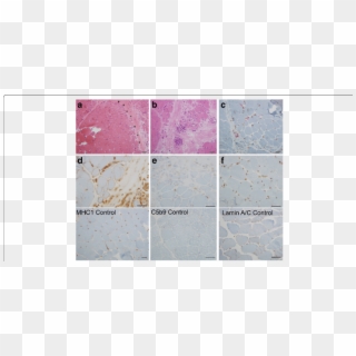 A Hematoxylin Eosin Staining Shows Prominent Perifascicular - Tile Clipart