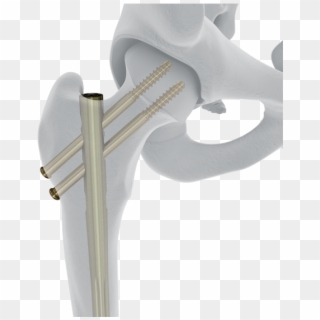 Femoral Recon Nail - Putter Clipart