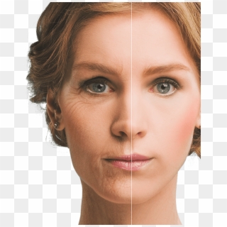 Woman's Face Before And After Botox - American Plastic Surgery Craze Clipart