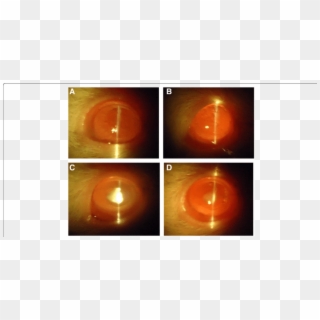 Slit Lamp Images Of Eyes - Light Clipart