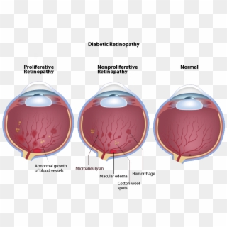 Click To Enlarge - Diabetic Retinopathy Vision Hd Clipart