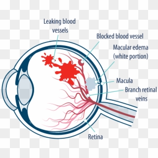 Eye With Macular Edema Following Retinal Vein Occlusion - Leaky Blood Vessels In Eyes Clipart