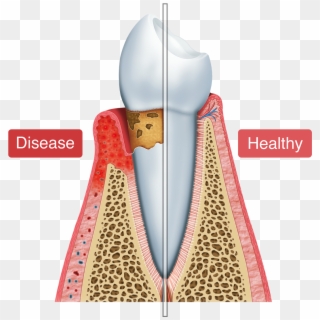 An Illustration Of Healthy Vs - Periodonto Png Clipart