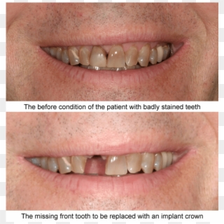 Before And After Case Examples All Of These Cases Shown - Tongue Clipart