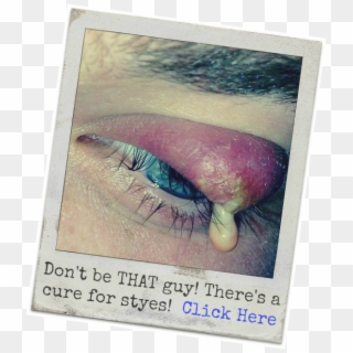 Woke Eyes Png - Stye Symptoms Clipart
